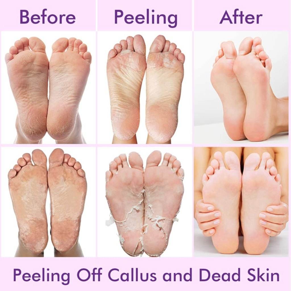 Foot Peeling Mask (Dead Skin Remover, Botanical Enriched) - ZEDIF